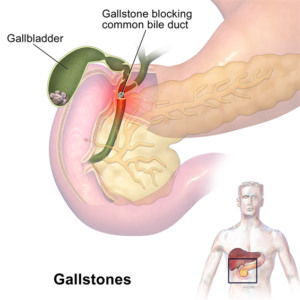 Gall Stone Laparoscopy Surgery
