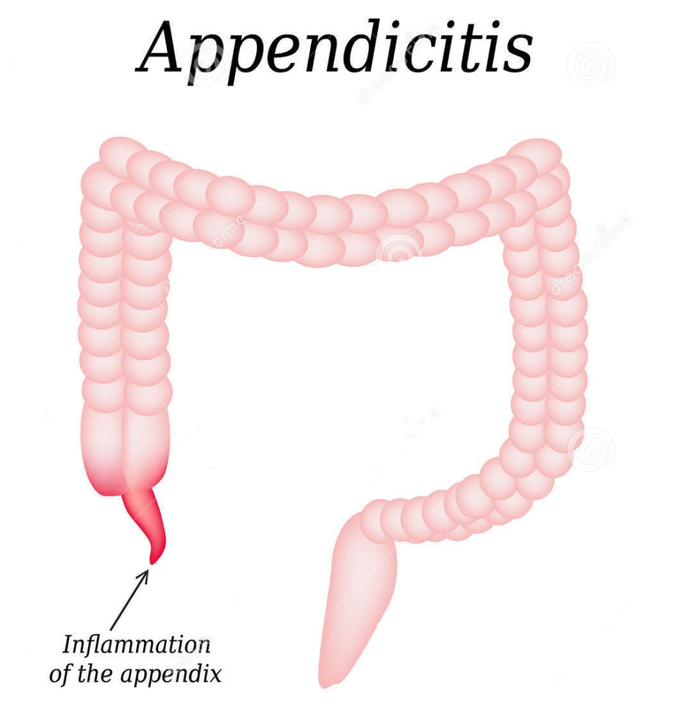 Appendicitis Symptoms Reasons Treatment Udumalpet Coimbatore